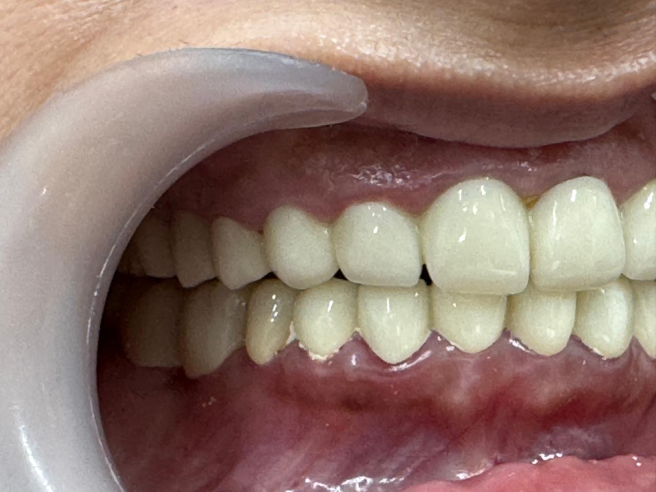 Full mouth rehabilitation: Severely attrited teeth restored with multiple root pins and zirconium crowns treatment
